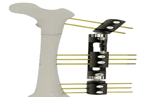 External Fixator Manufacturer in Delhi